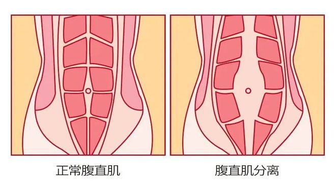 漏尿、松弛、肚子大……别再忍！这个修复方法在家就能做(图8)